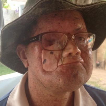 Povoado em Goiás tem a maior taxa mundial de doença rara de pele