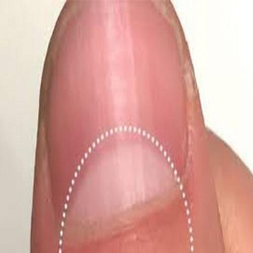 Você possui manchas brancas semicirculares nas unhas? Veja o que elas