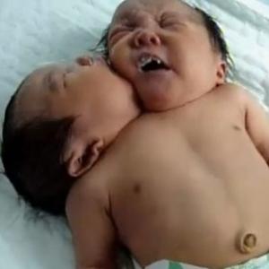 Bebê com duas cabeças nasce na China.