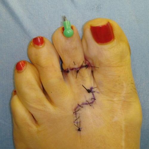 Cirurgia da Cinderela - A cirurgia dos pés