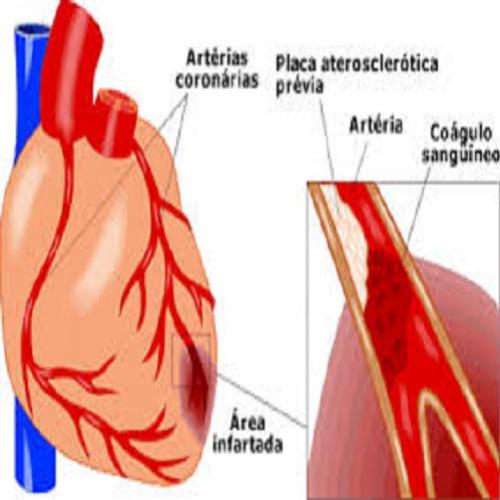 Como ajudar a desentupir artérias coronarianas naturalmente