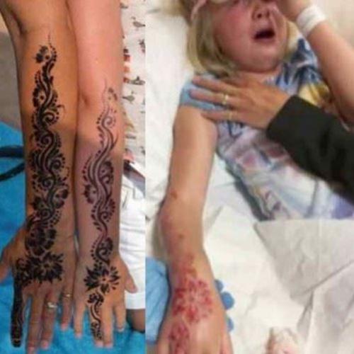 Tatuagem de hena provoca queimaduras graves