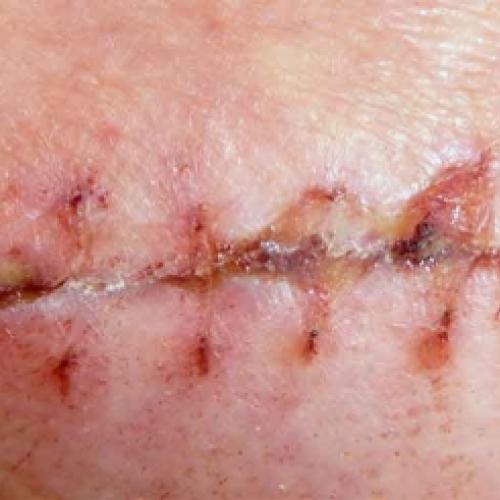 A cura de uma ferida sem deixar cicatriz já é possível.
