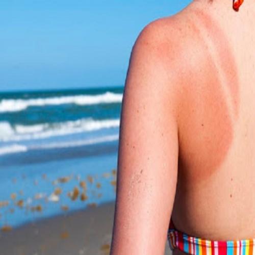 5 remédios caseiros para tratar queimaduras de sol