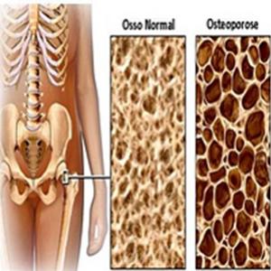 Osteoporose: uma doença silenciosa