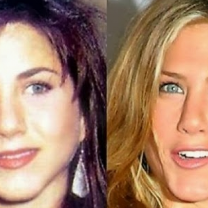 Top 10 Celebridades antes e depois da cirurgia plástica