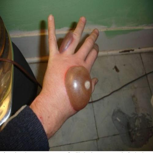 O que acontece se você colocar sua mão em nitrogênio líquido