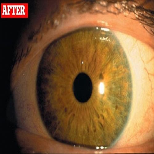 Medicamento para aumentar os cílios está transformando olhos verdes em