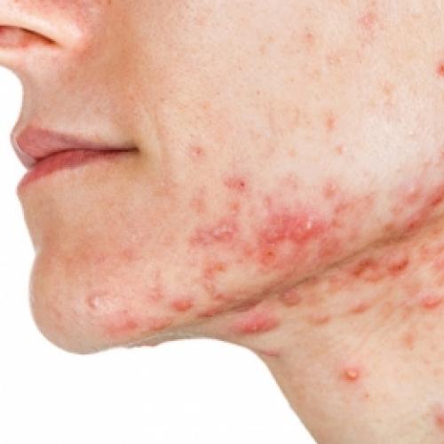 10 remédios caseiros para combater a acne
