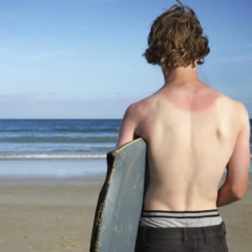 Dicas para evitar e  combater queimaduras de sol e praia