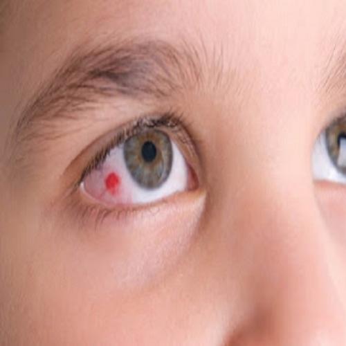 Hiposfagma - derrame ocular na superfície do olho