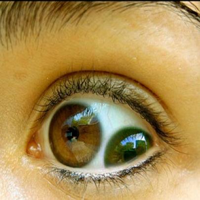 Olhos com duas pupilas : Duplex pupula veja o que é isso