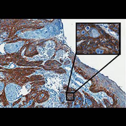 Análise de proteína auxilia a planejar tratamento de câncer de vulva