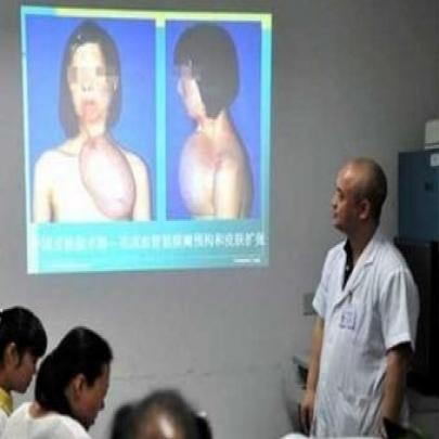 Chinesa recebe transplante de rosto criado no seu peito