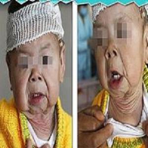 Chinesa de 1 ano sofre de doença rara de pele que a faz parecer idosa