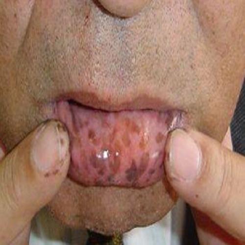  Podem ser graves essas manchas labiais? 