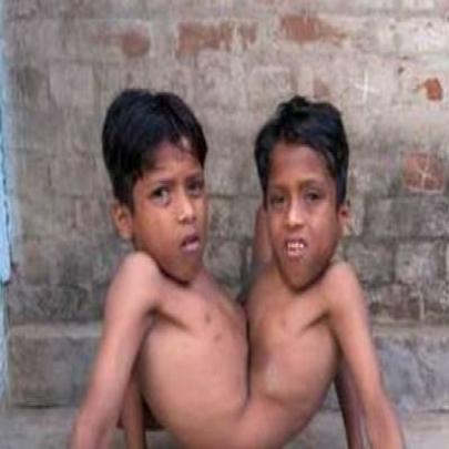 Gêmeos siameses são adorados como encarnação divina na Índia