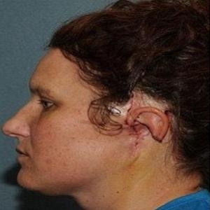 Incrível: médicos reconstroem a orelha de uma mulher