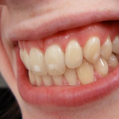 2 dicas infalíveis para você remover manchas dos dentes