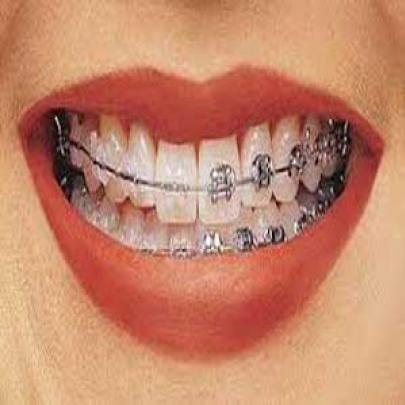 Entenda tratamento ortodôntico para alinhamento dos dentes