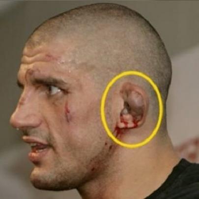 Saiba o motivo por que as orelhas dos lutadores ficam deformadas