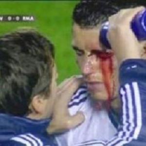 Cristiano Ronaldo sofre traumatismo facial durante jogo